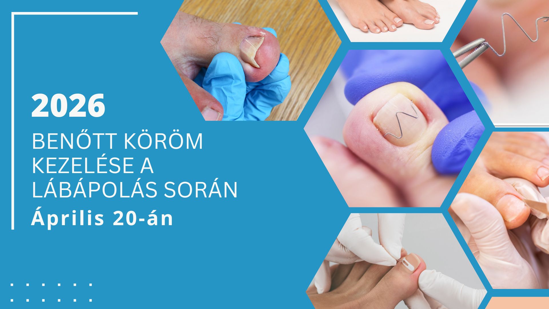 Benőtt köröm kezelése a lábápolás során